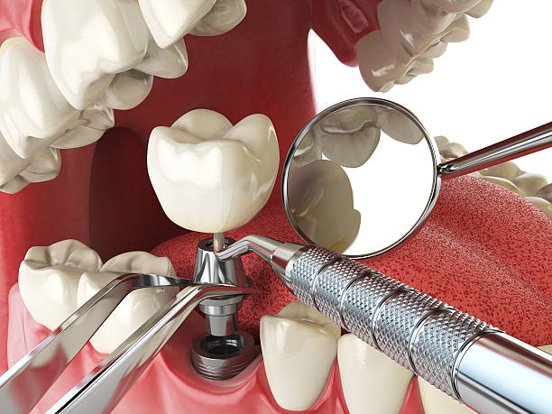 Best Emergency Root Canal Treatment in East Washington, PA